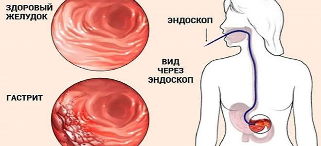 Где болит желудок у человека фото при гастрите